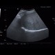 Focal nodular hyperplasia, liver: US - Ultrasound